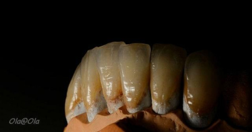 Ceramika dentystyczna #CeramikaDentystyczna #korony #mosty #ZębyZPorcelanany